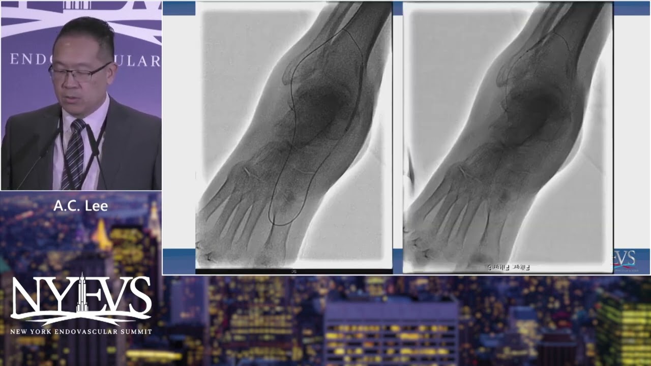 Tibial and Pedal Artery (BTK/BTA) Anatomy