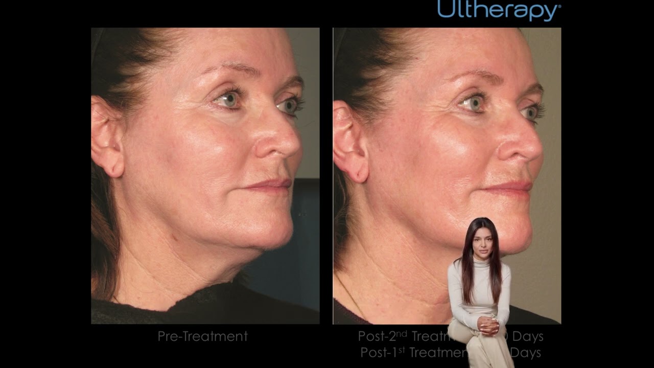Skin Tightening In Staten Island Sofwave | Kalon Dermatology – Medical & Cosmetic Dermatology