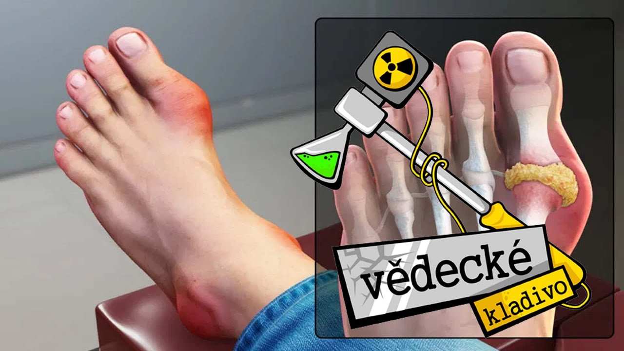 Co je to dna (královská nemoc)? - Vědecké kladivo AK 9