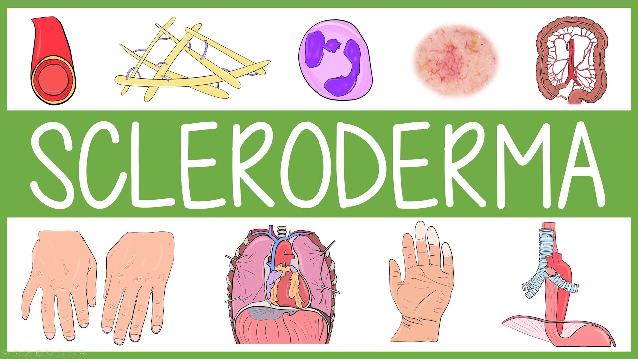 Scleroderma Visually Explained