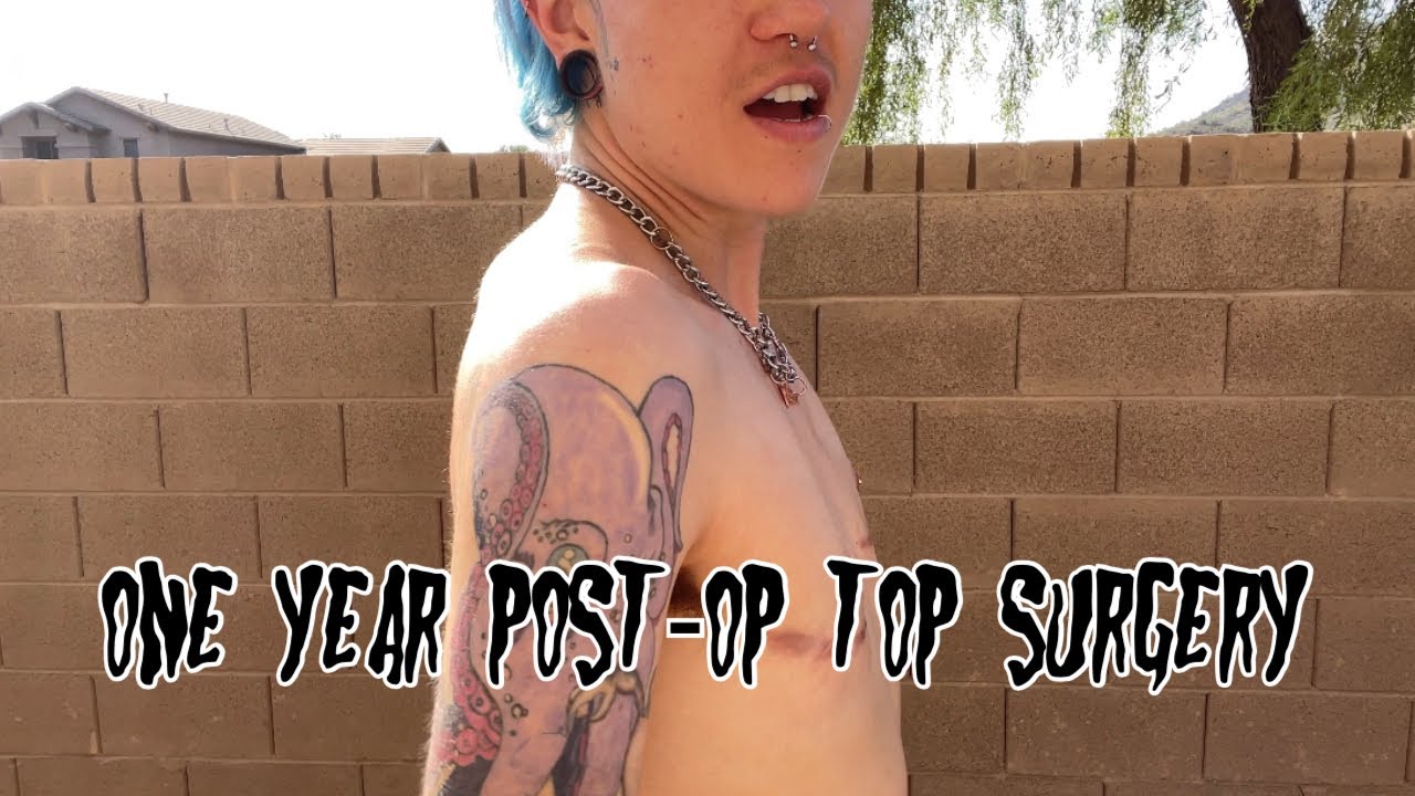 ONE YEAR POST-OP TOP SURGERY TRANS