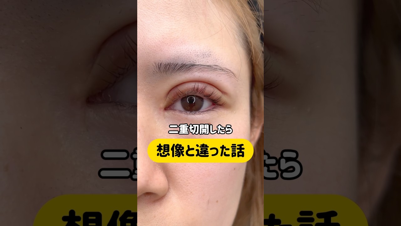 二重切開の仕上がりが想像と違った