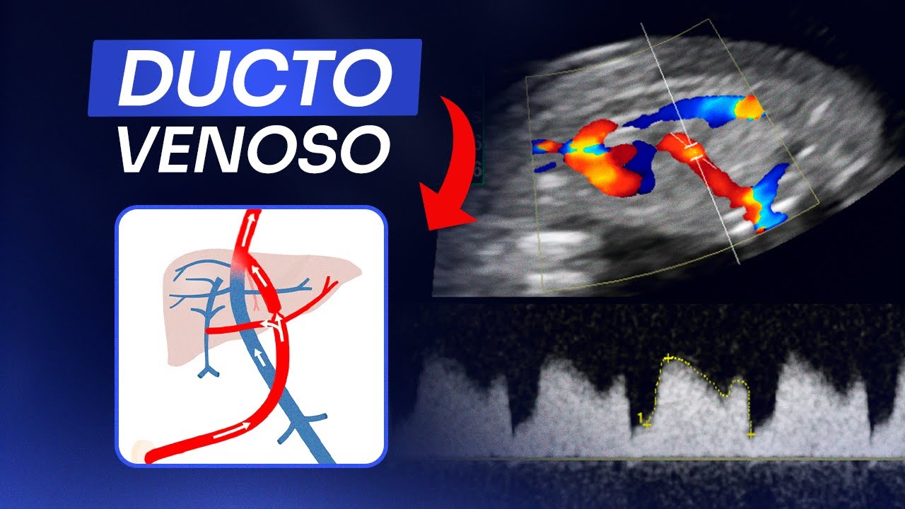 Avaliação do Ducto Venoso no Doppler obstétrico | Ultrassom obstétrico