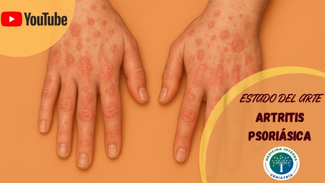 Artritis Psoriásica