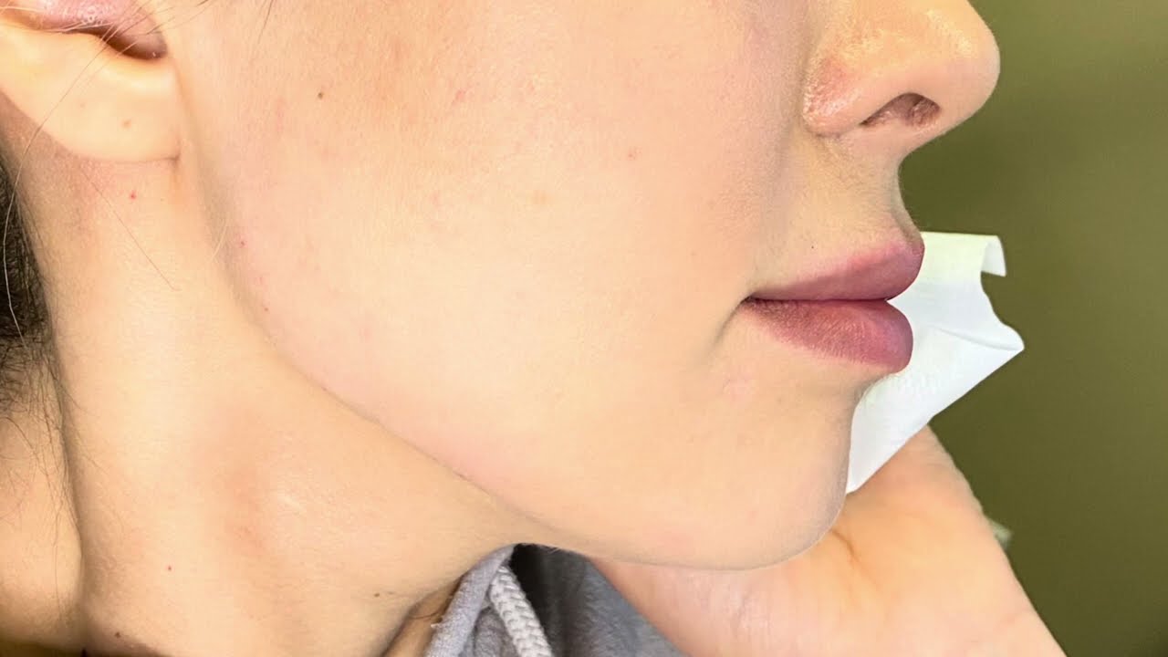 Filler Jawline at OC MedDerm by Dr. Shafa #jawline #jawlinefiller #dermatology #dermatologist