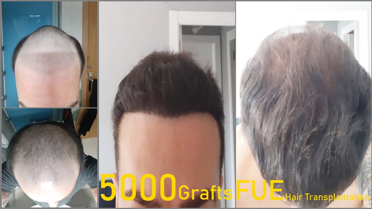 Aisha Hair Transplant Result in Turkey / Aisha Hair Resultado Post Injerto Capilar En Turquía