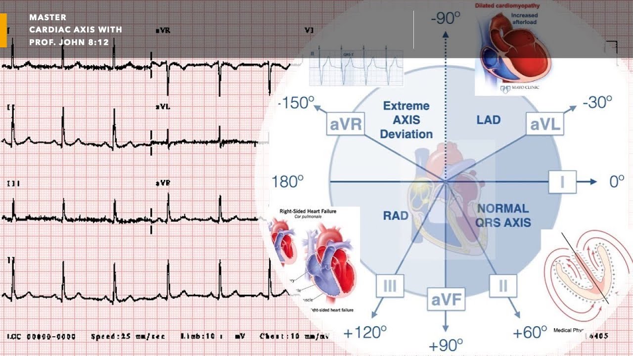 ECG Cardiac Axis | USMLE Physiology & Cardiology