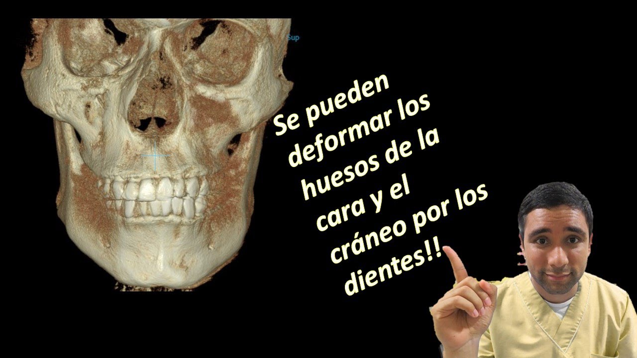 Tienes la Cara y la mandíbula  desviadas? Un ojo mas pequeño que otro? Pueden ser tus dientes!!👁👀