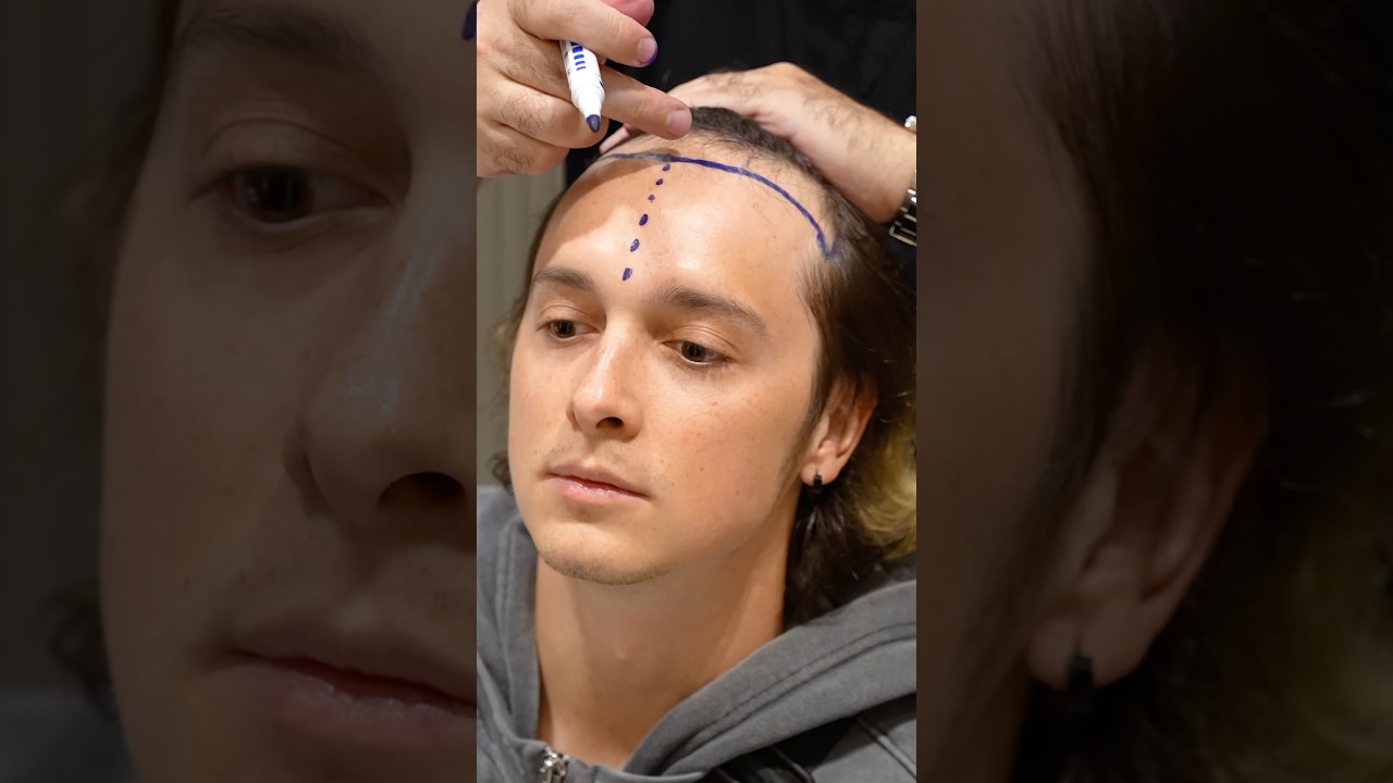 Cosmedica Clinic Hair Transplant in Turkey #shorts #hairtransplant #video