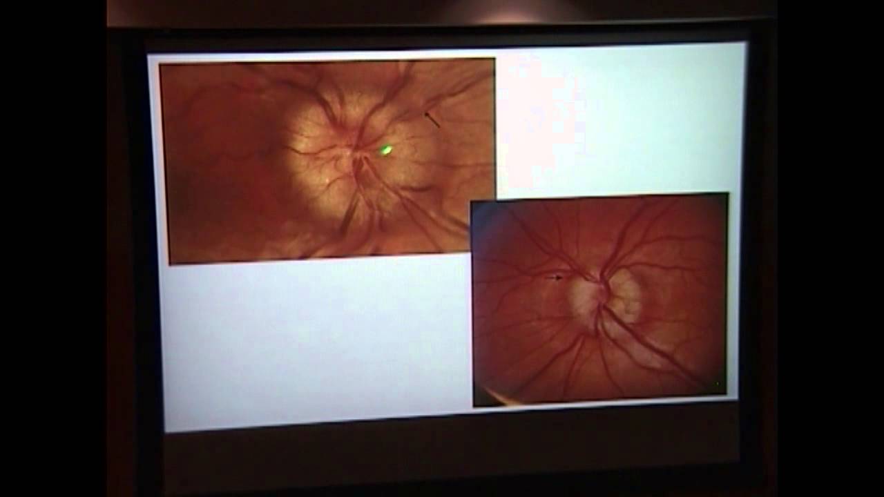 Optic Disc Drusen