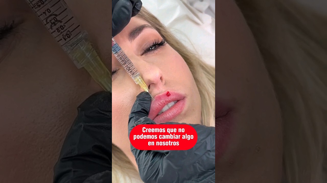 y as&iacute; qued&oacute;!! &iquest;Qu&eacute; te parece este resultado de aumento de labios con &aacute;cido hialur&oacute;nico?