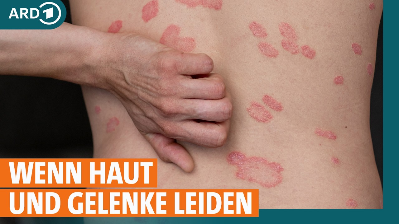Schuppenflechte behandeln: Ursachen und was hilft bei Psoriasis? I ARD Gesund