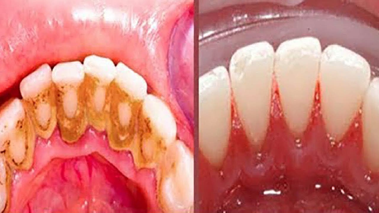 4 mani&egrave;res d&rsquo;&eacute;liminer le tartre des dents naturellement