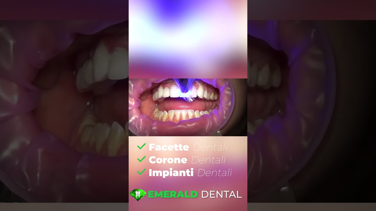 Faccette Dentali | Emerald Dental