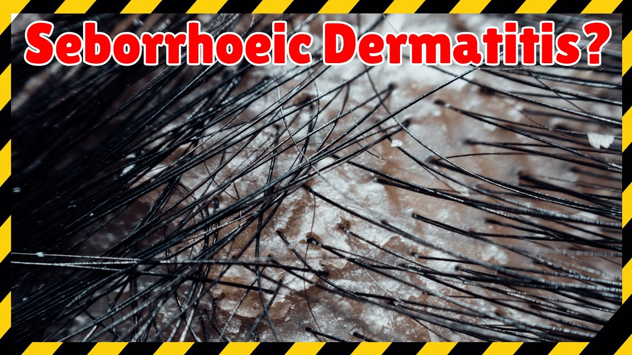 Seborrheic Dermatitis Hair Loss: Causes, Scalp Fungus & Regrowth Tips