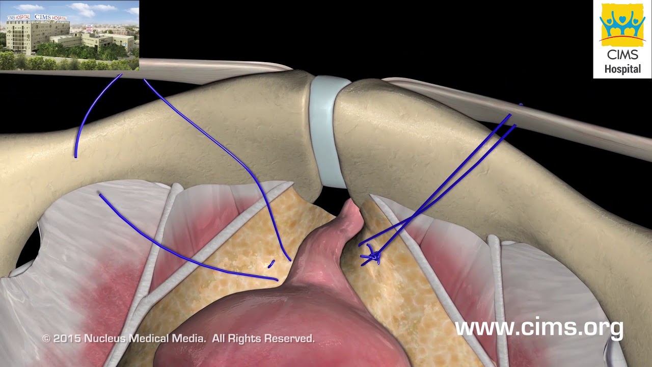 Stress Urinary Incontinence - CIMS Hospital