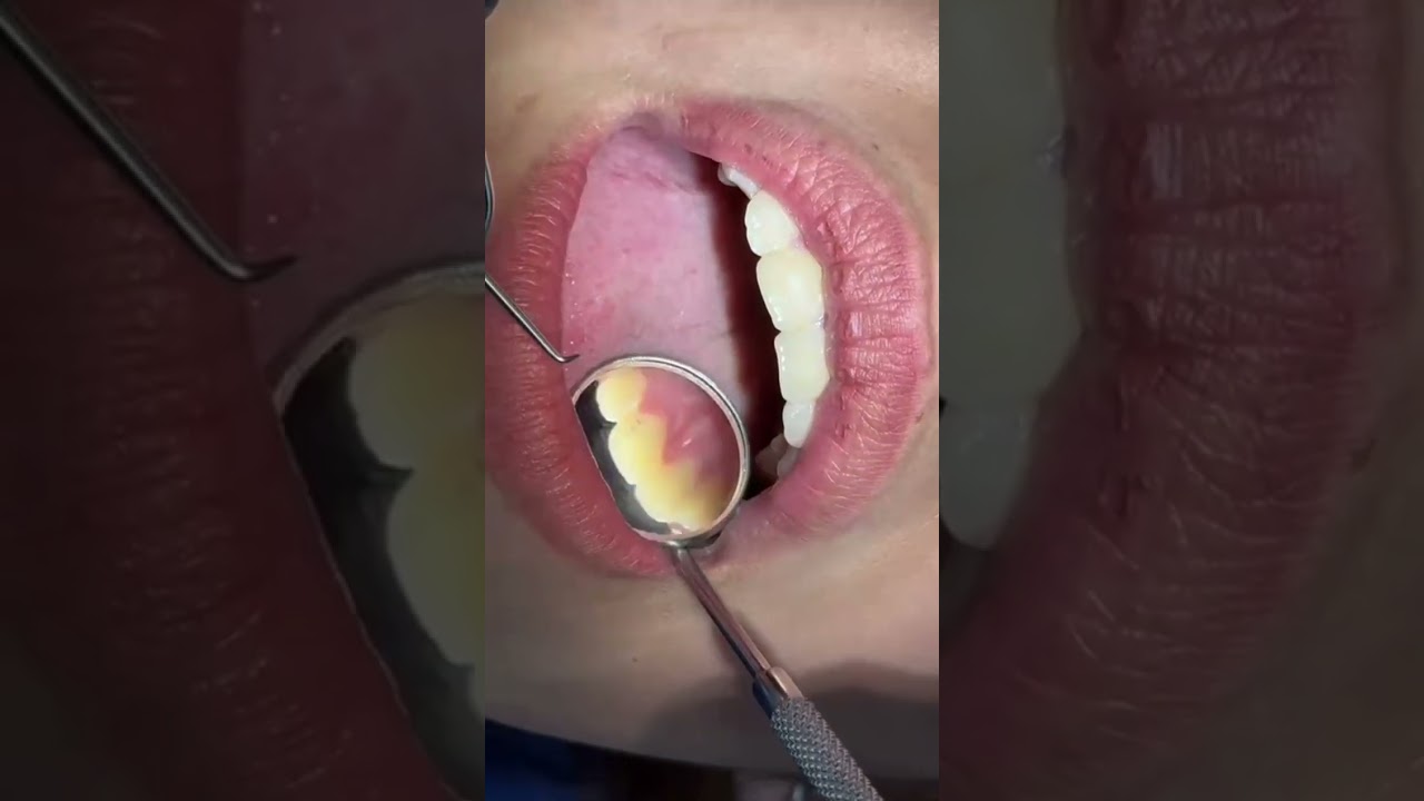 Exploración intra oral y extraoral