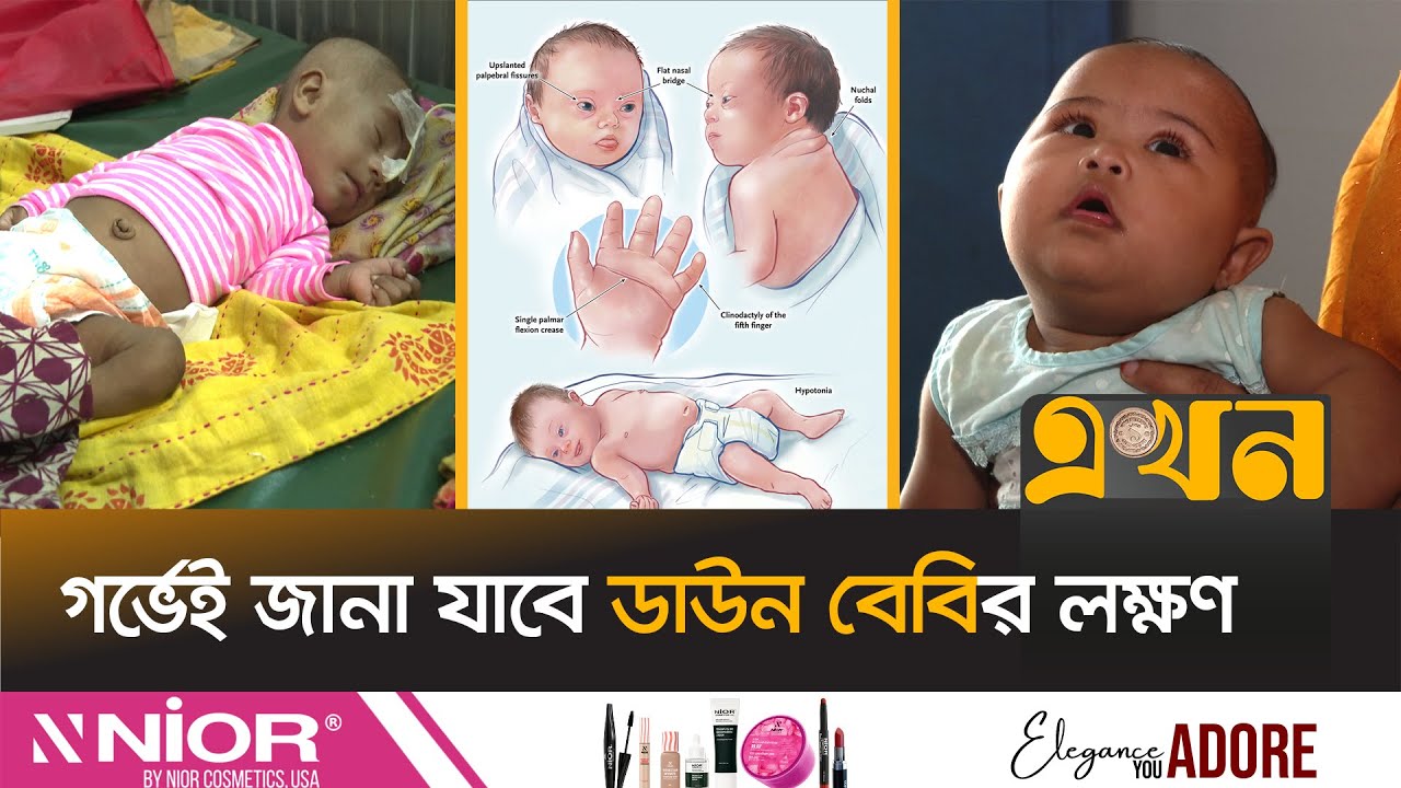 ডাউন সিনড্রোম নারীর সম্পূর্ণ সুস্থ সন্তান জন্মদান | Down Syndrome | Health & Medical | Ekhon TV