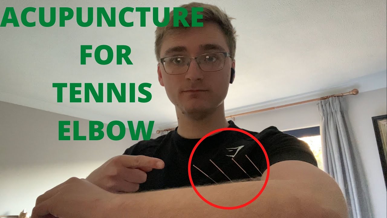 Acupuncture For Tennis Elbow (what to expect from acupuncture and how it can help)