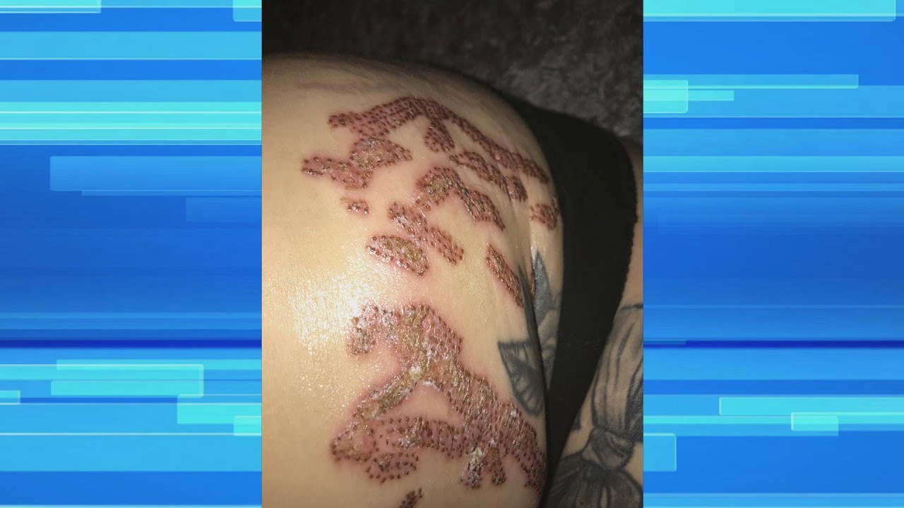 Stretch Mark Procedure Gone Wrong!
