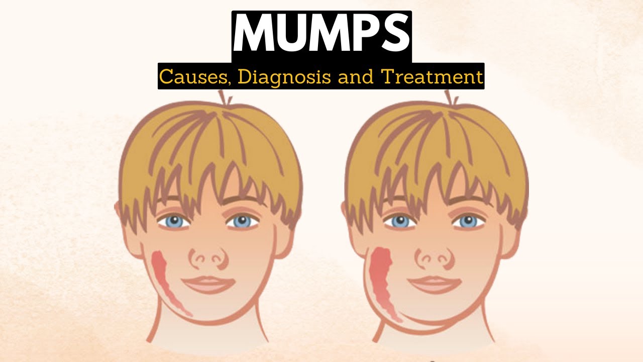 Mumps, Causes, Signs and Symptoms, Diagnosis and Treatment.