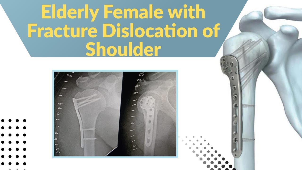 PROXIMAL HUMERUS PERIARTICULAR PLATE (PHPP ) FOR  FRACTURE DISLOCATION OF SHOULDER IN A 60/F.