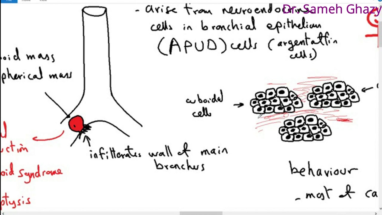 Systemic pathology 39 : respiratory system 5 ( tumors of lung ) DR.SAMEH GHAZY