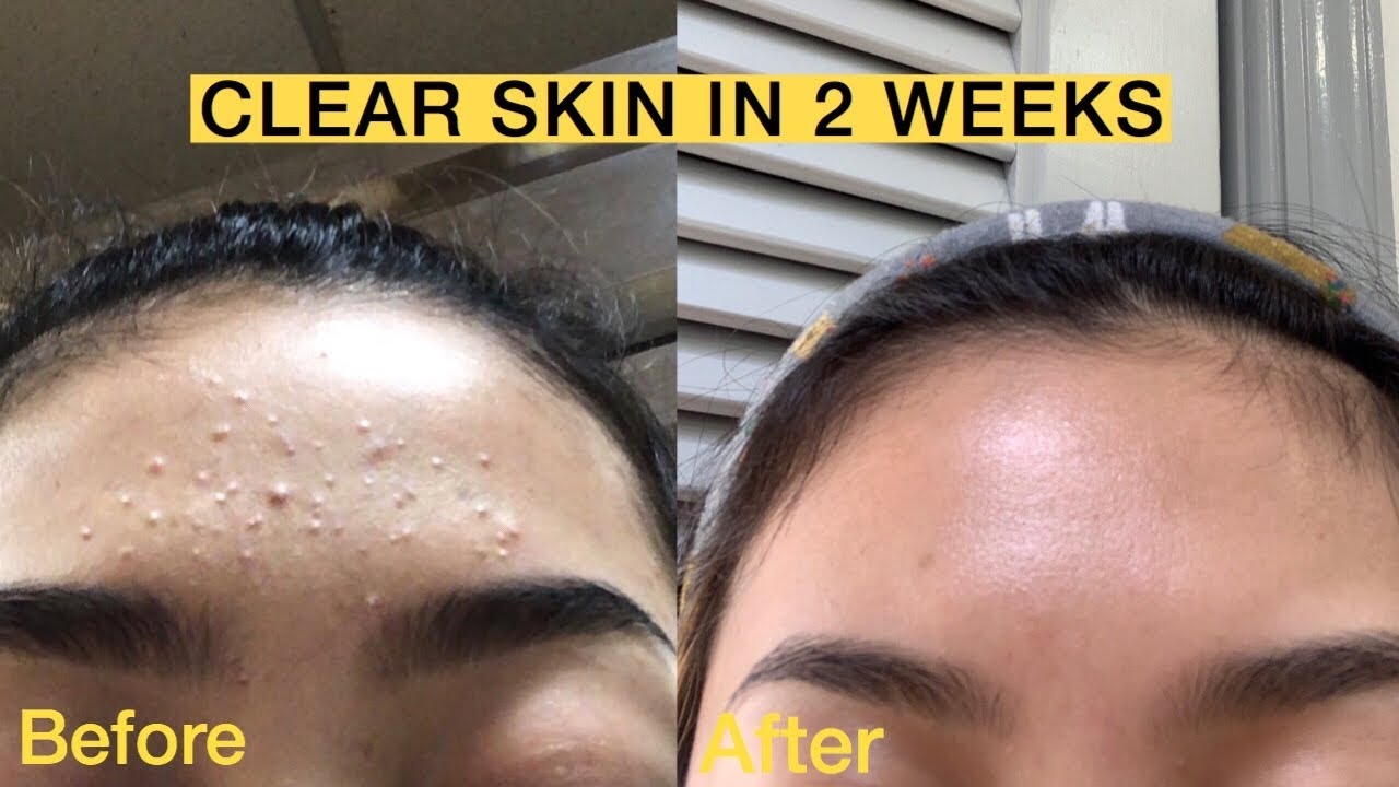 How I transformed my skin's texture within 2 weeks!⎪My Daytime and Nighttime skincare routine