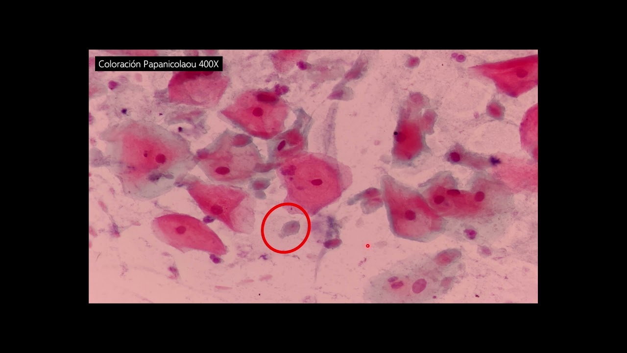 Identificación de Trichomonas vaginalis en Citología