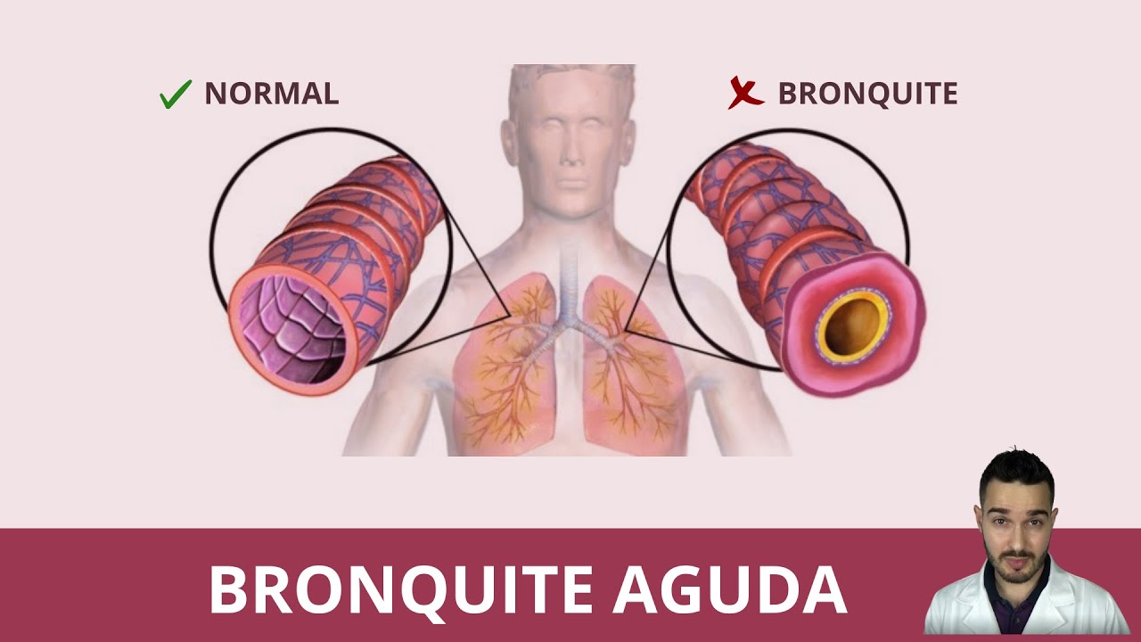 [ TUDO SOBRE ] BRONQUITE AGUDA