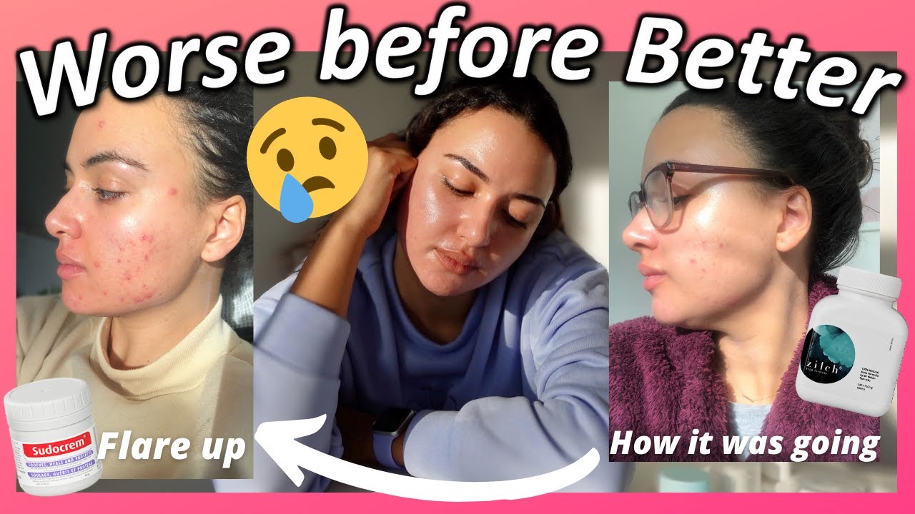 TRETINOIN 6 MONTHS | Before and After | Tretinoin 0.05% cream & Hydroquinone | Acne prone | Zilch 💊