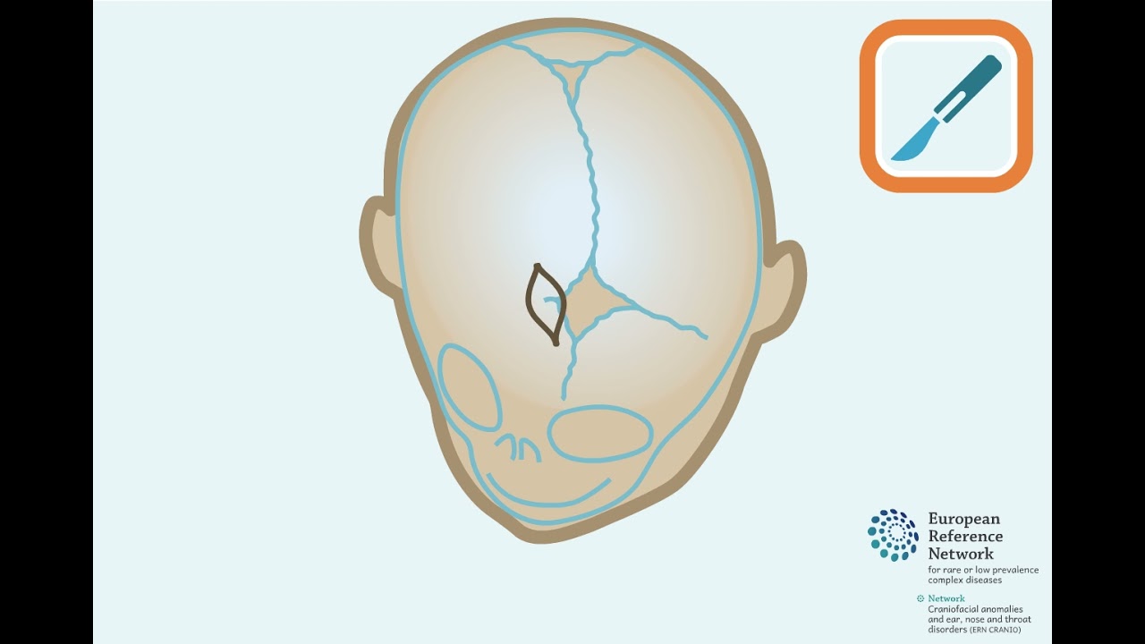 Endoscopically assisted suturectomy for anterior plagiocephaly