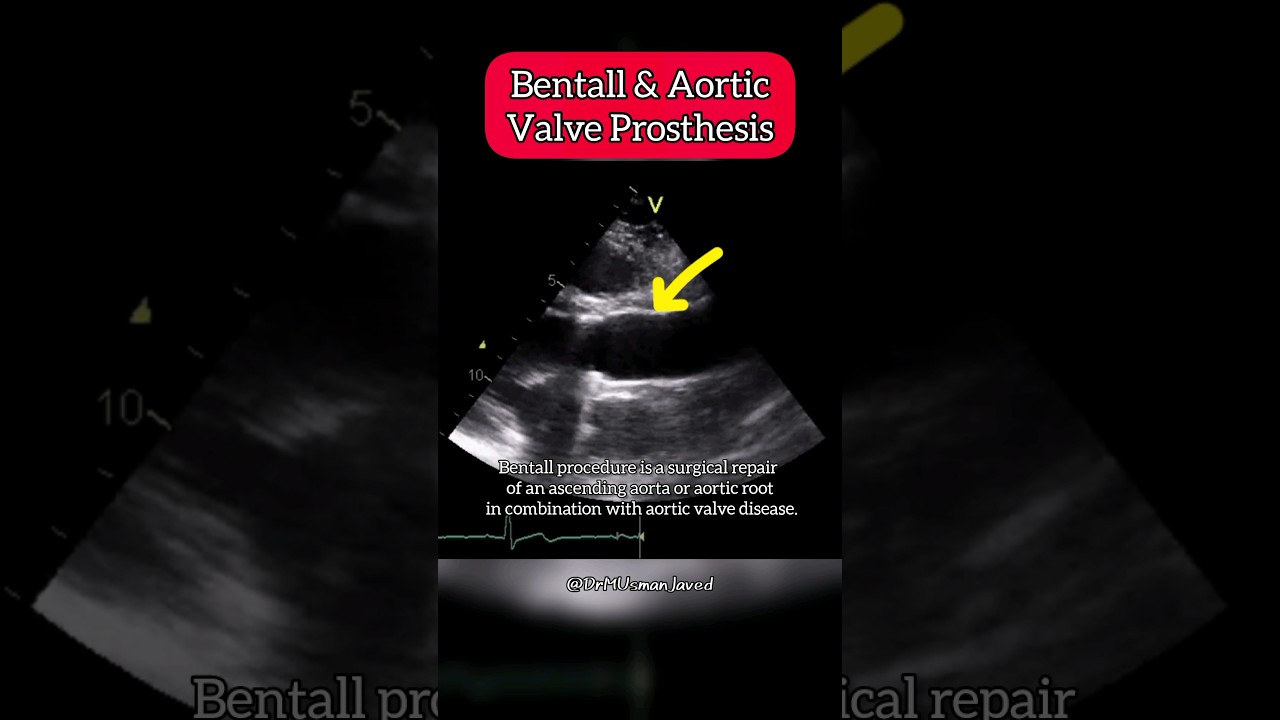 Bentall and aortic Valve Prosthesis on Echocardiography #aortic #Heart