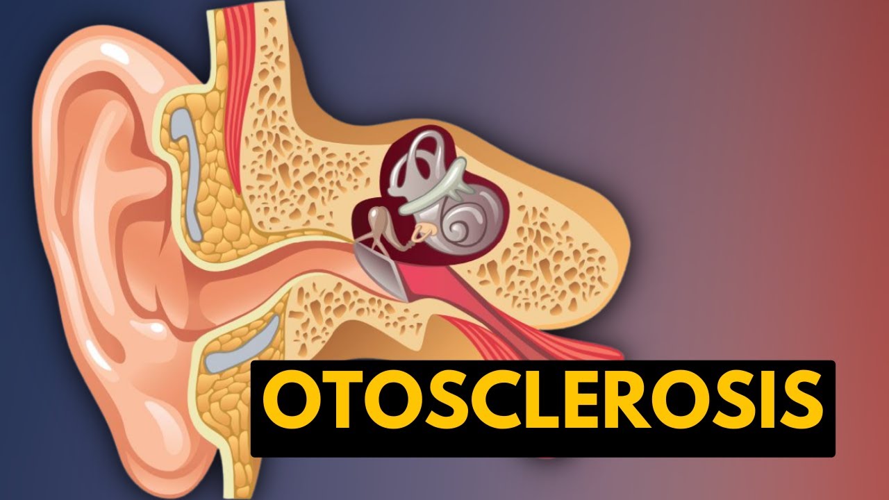 OTOSCLEROSIS, Causes, Signs and Symptoms. Diagnosis and Treatment.