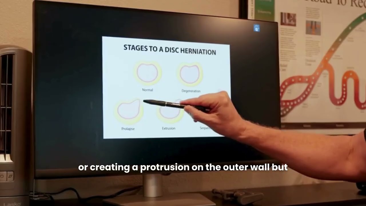 What's the Best Treatment for a Herniated Disc? | Lake Stevens Chiropractic