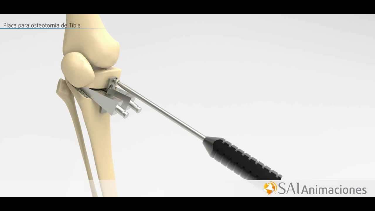 South America Implants S.A. - DC 522-00 Placa para Osteotomía de Tibia