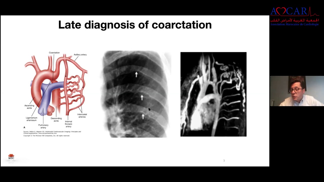 Revue des cardiopathies congénitales - Dr. Damien Bonnet