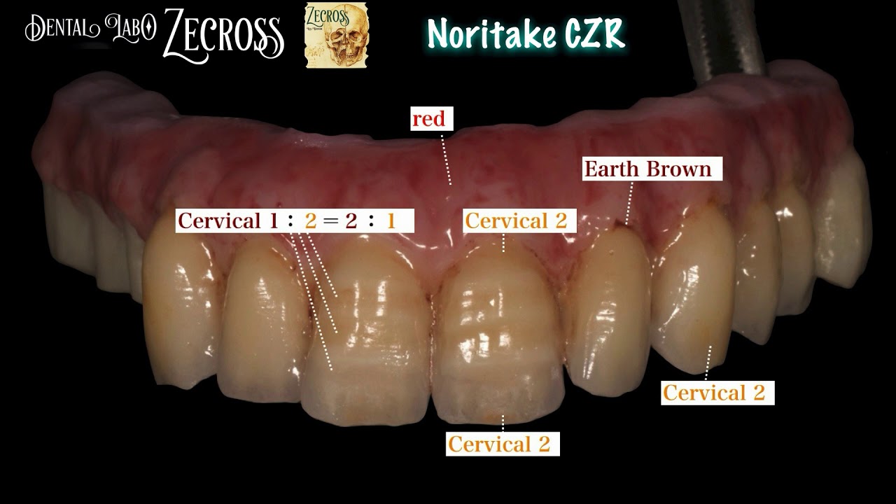 インプラント技工　Full mouth Noritake CZR build up　#dental technology #Noritake #インプラント　#オールオン4 #Zirconia