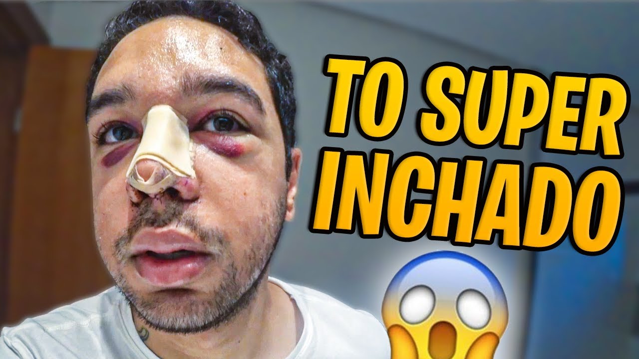 DEU RUIM NA MINHA RECUPERAÇÃO - MUITA DOR E INCHAÇO