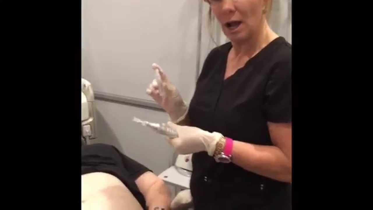 Micro needling stretch mark treatment demonstration - Results May Vary