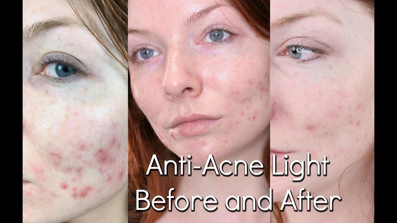 BlueMD Light Therapy Review |Trophy Skin | Before & After