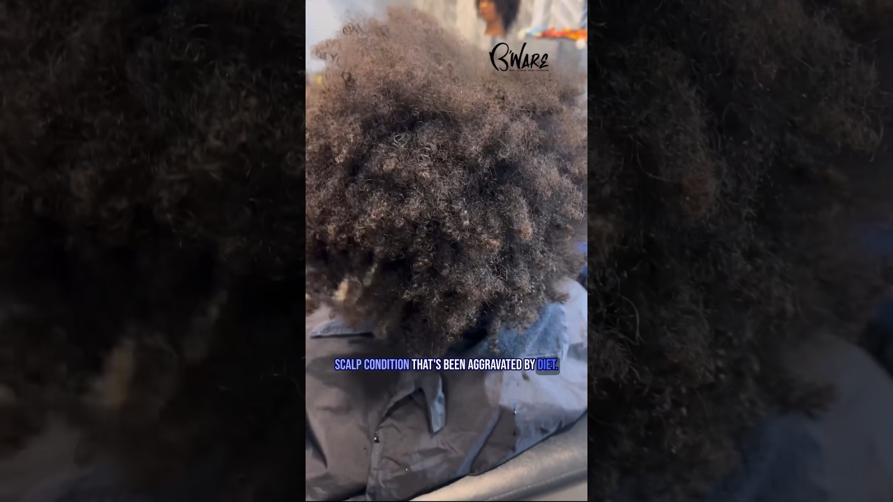 🦋Scalp condition viewed 200X 😳!! #shorts #scalp #zoom #scalpcare #naturalhair #curlyhair #scope🦋