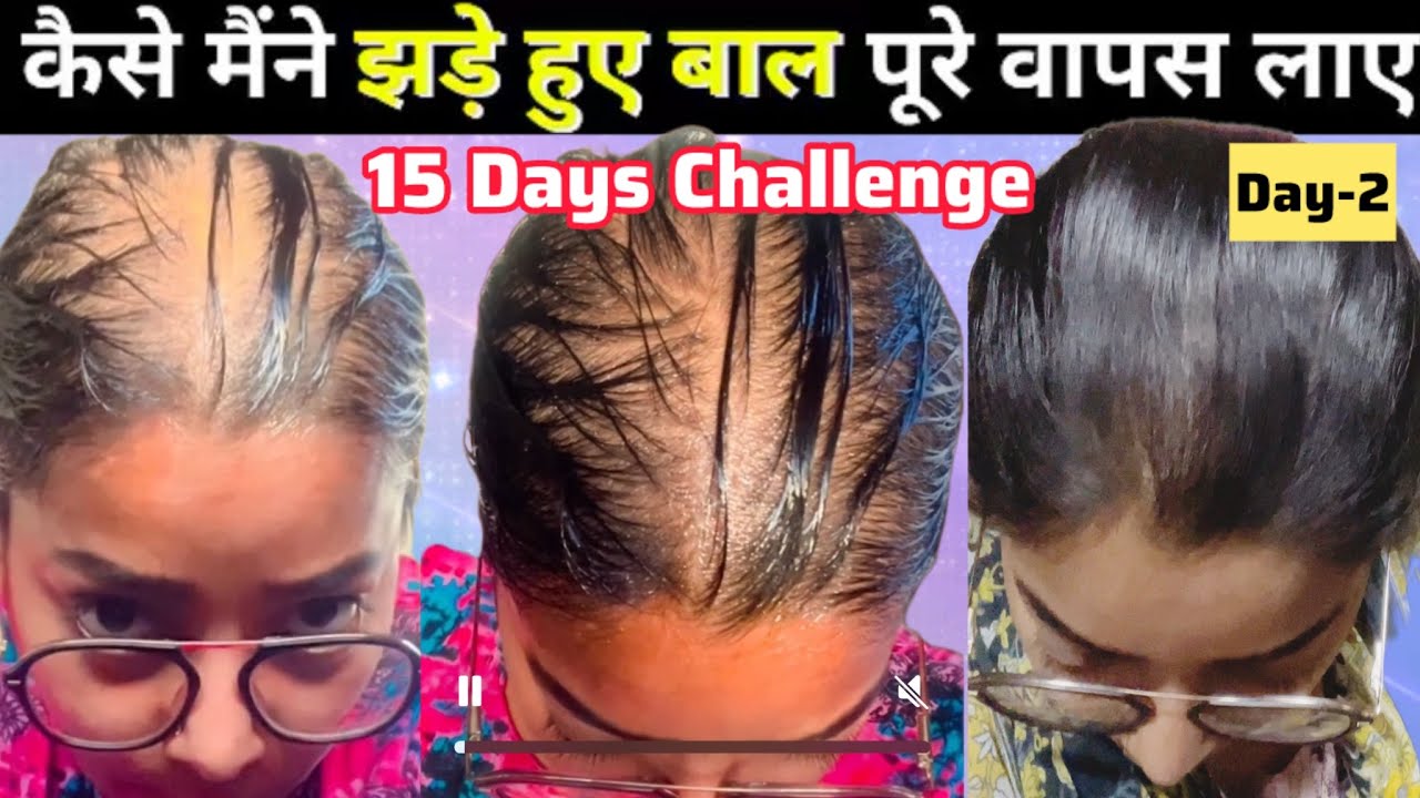 15 Days Hair Growth Challenge👍Hair Growth Serum🌿Day-2 Super Healthy Scalp#bald#hairgrowth#viralvideo