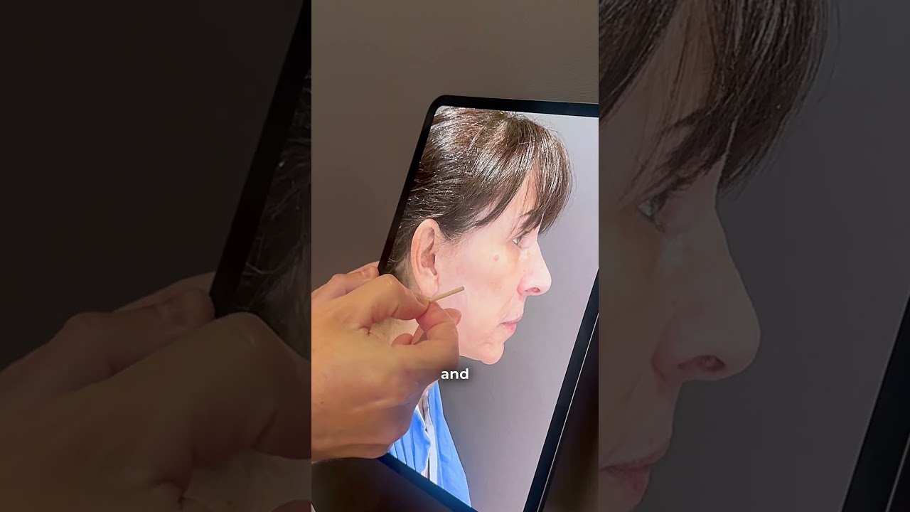 3 Kinds of Facelifts