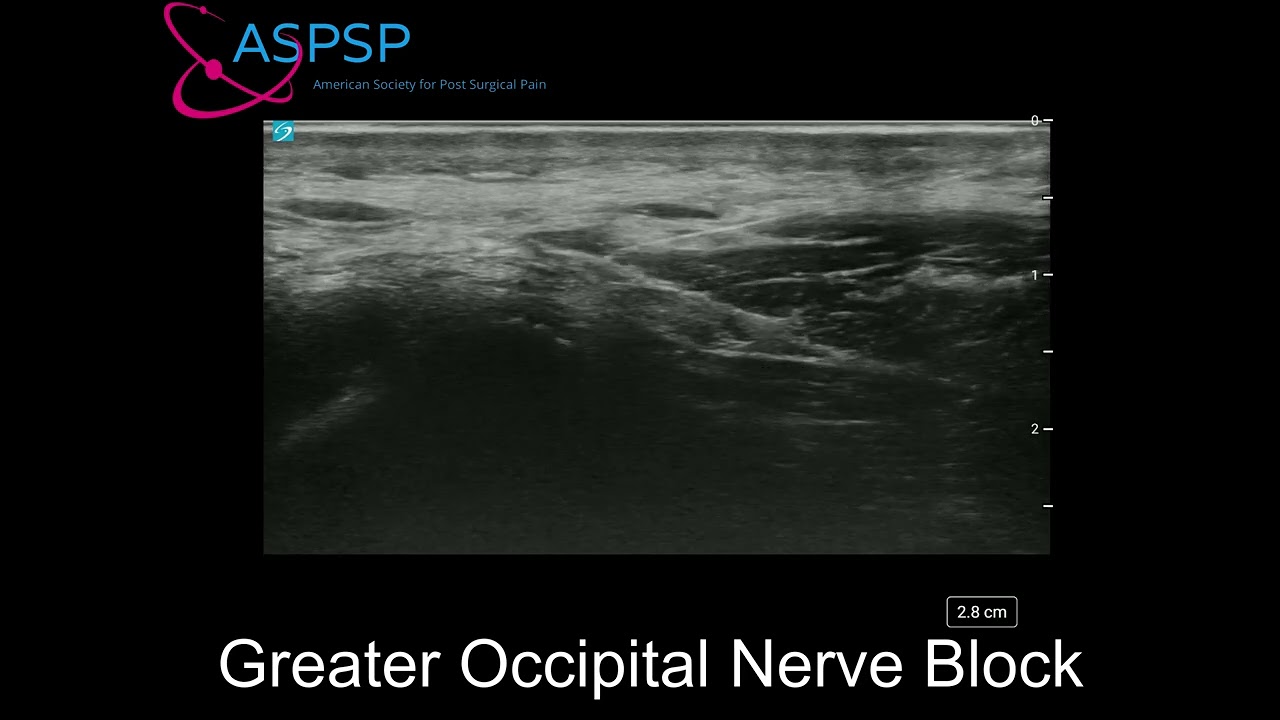 Ultrasound Guided Greater Occipital Nerve Block