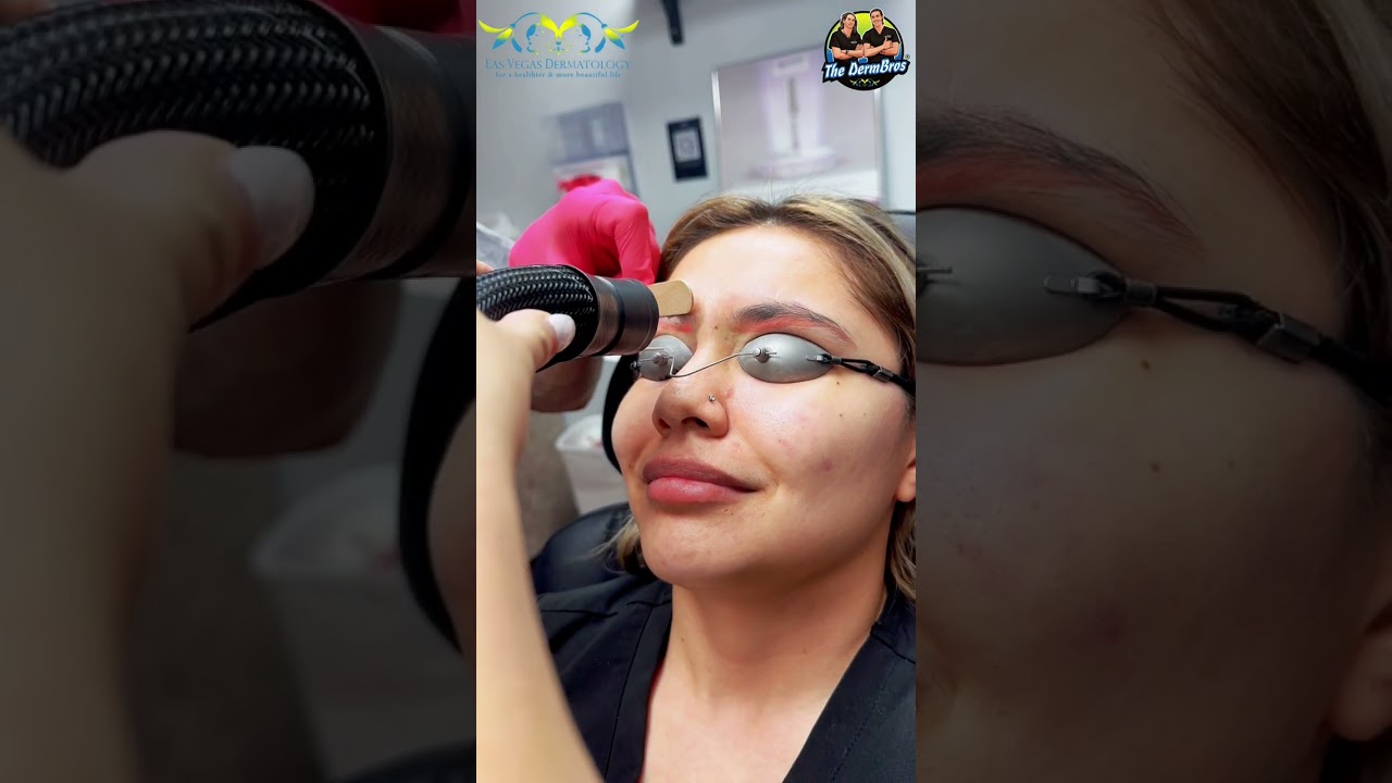 Microbladed Eyebrows Treated w Laser⚡️Tattoo Removal by Dr. H.L. Greenberg at Las Vegas Dermatology®