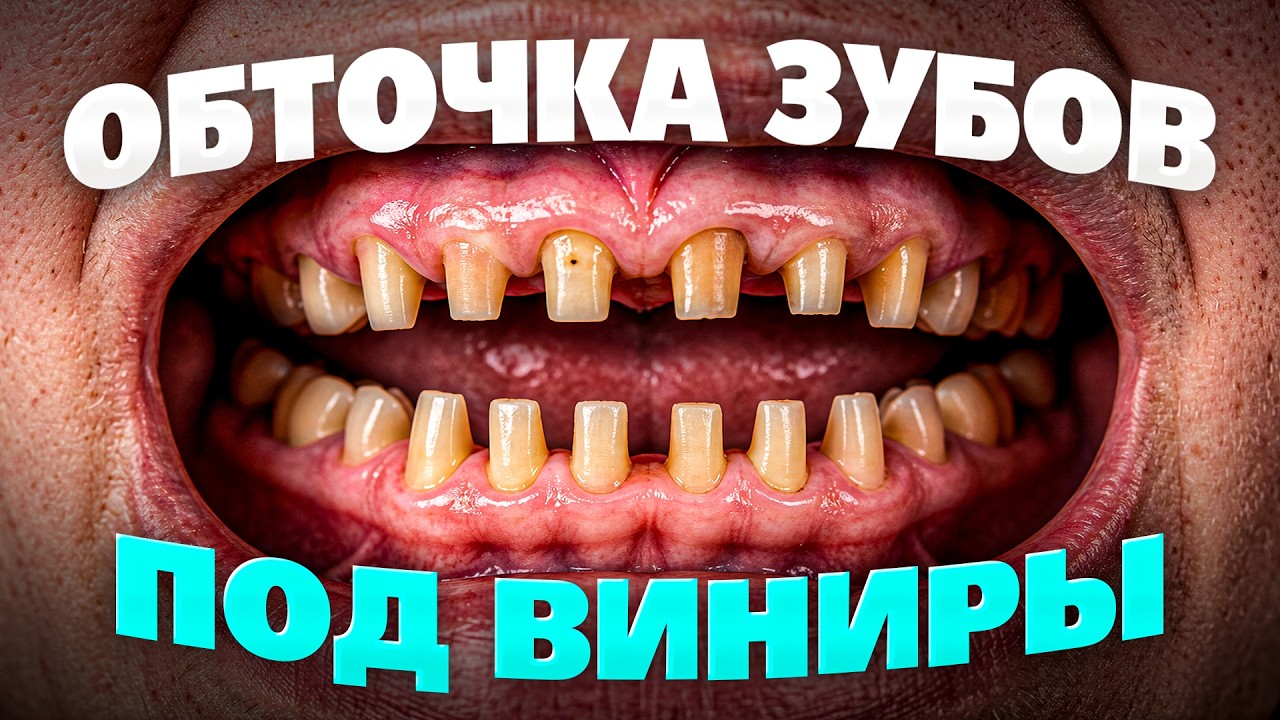Самый ГЛАВНЫЙ ОБМАН про установку ВИНИРОВ