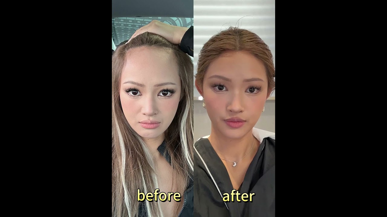 High Hairline Made Me Look Older… 1 Month After Hair Transplant My Face Looks Smaller!