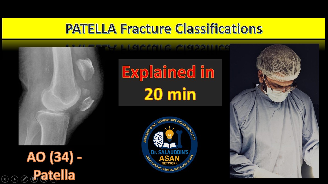 All Patella Fracture Classifications in 20 Minutes | Orthopaedics Quick Revision