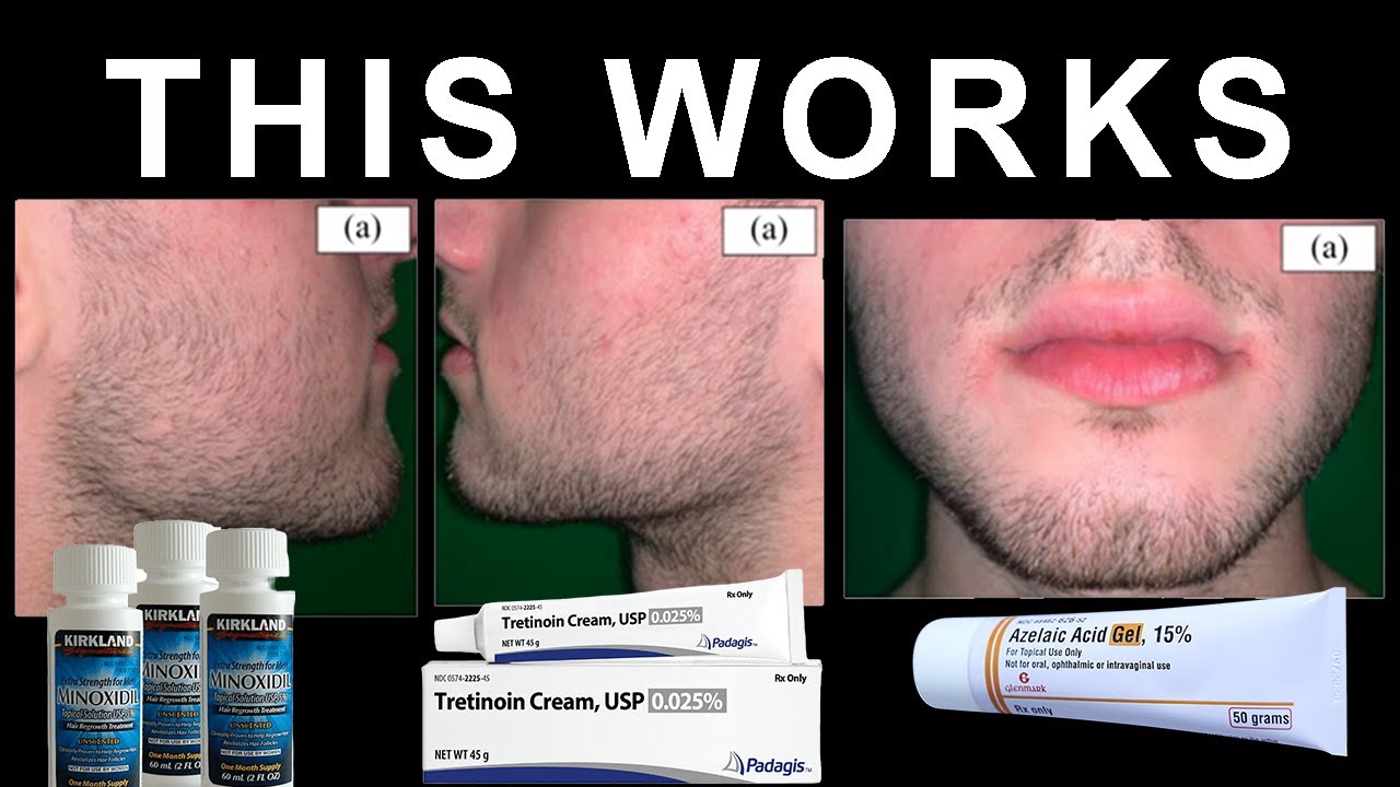 BEST Minoxidil Beard Growth Protocol: NO BS